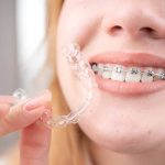 INVISALIGN VS. TRADITIONAL BRACES: THE ULTIMATE 2025 COMPARISON MADE SIMPLE