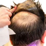 Revitalizing Your Confidence: The Ultimate Hair Loss Solutions